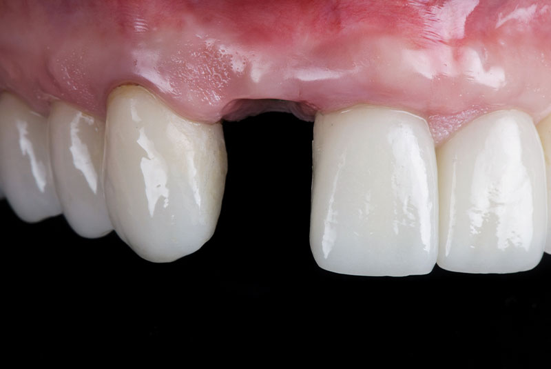 Missing tooth