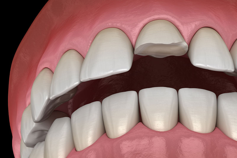 Broken tooth