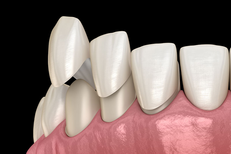 Veneers