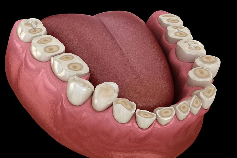 Dental veneers model
