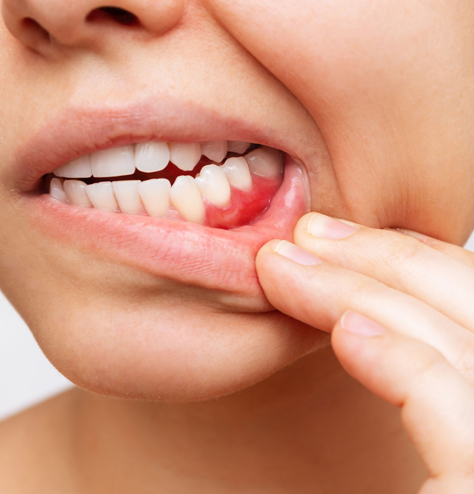 Gum disease