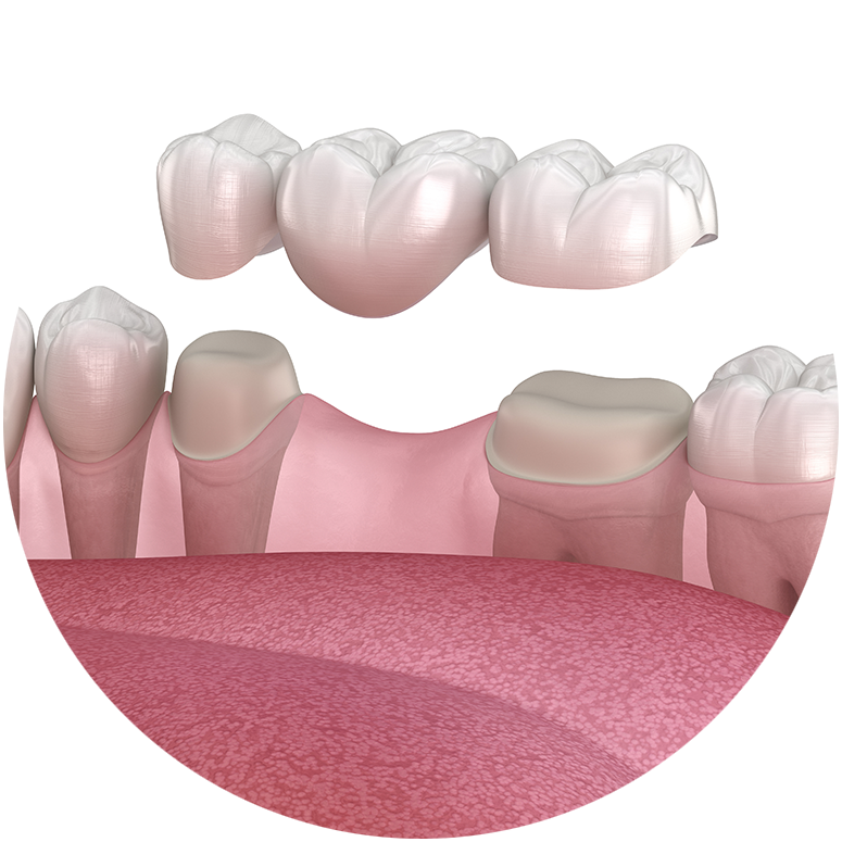 Dental Bridge