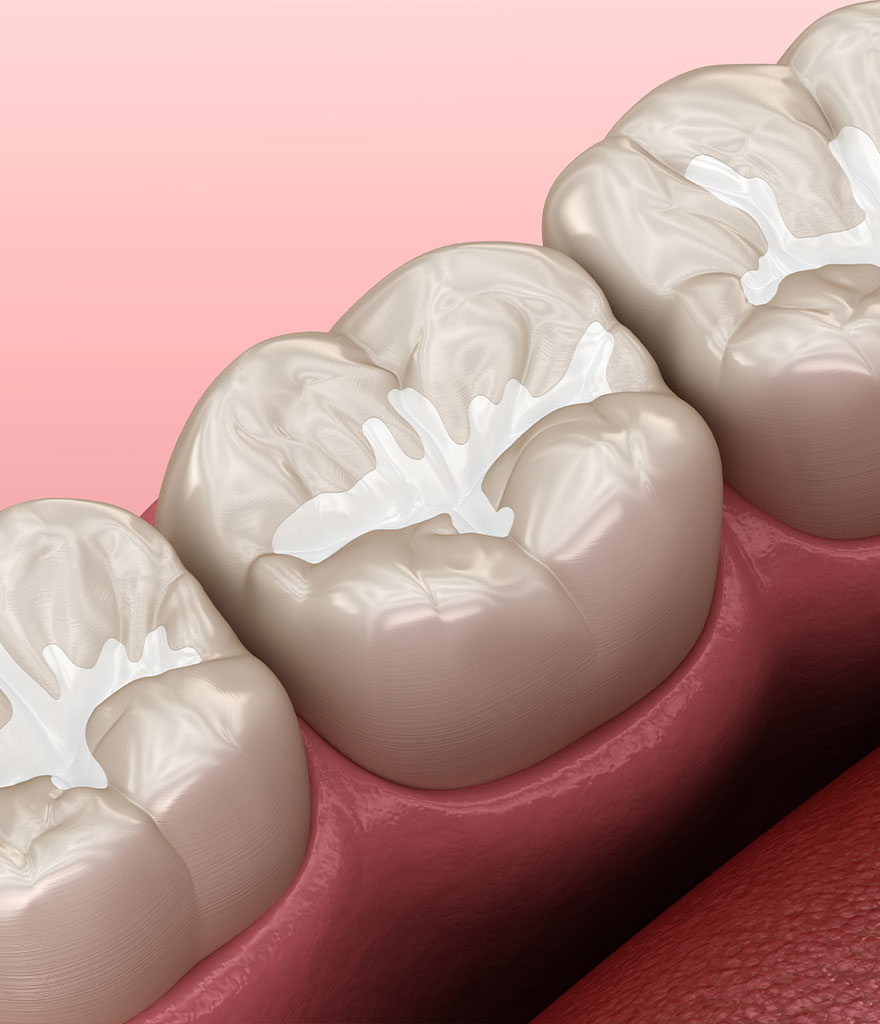 Dental Fillings