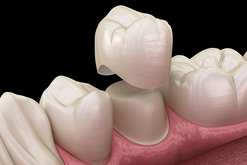 dental Crown