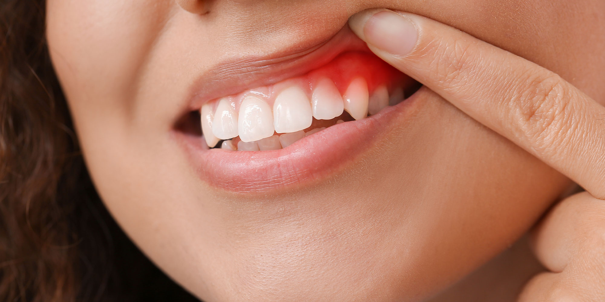 Gum disease