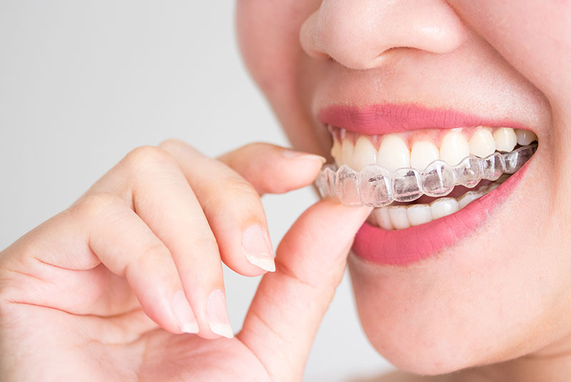 Invisalign
