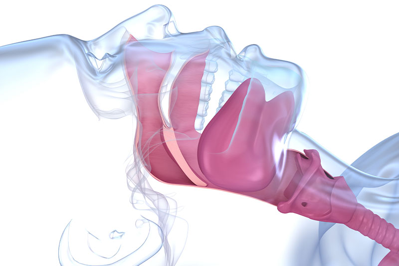Sleep apnea
