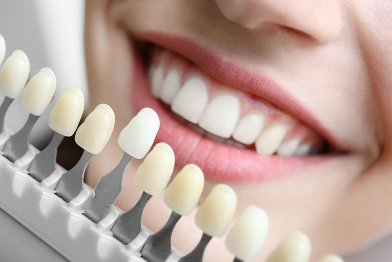 close up of person having their teeth compared to a whitening chart