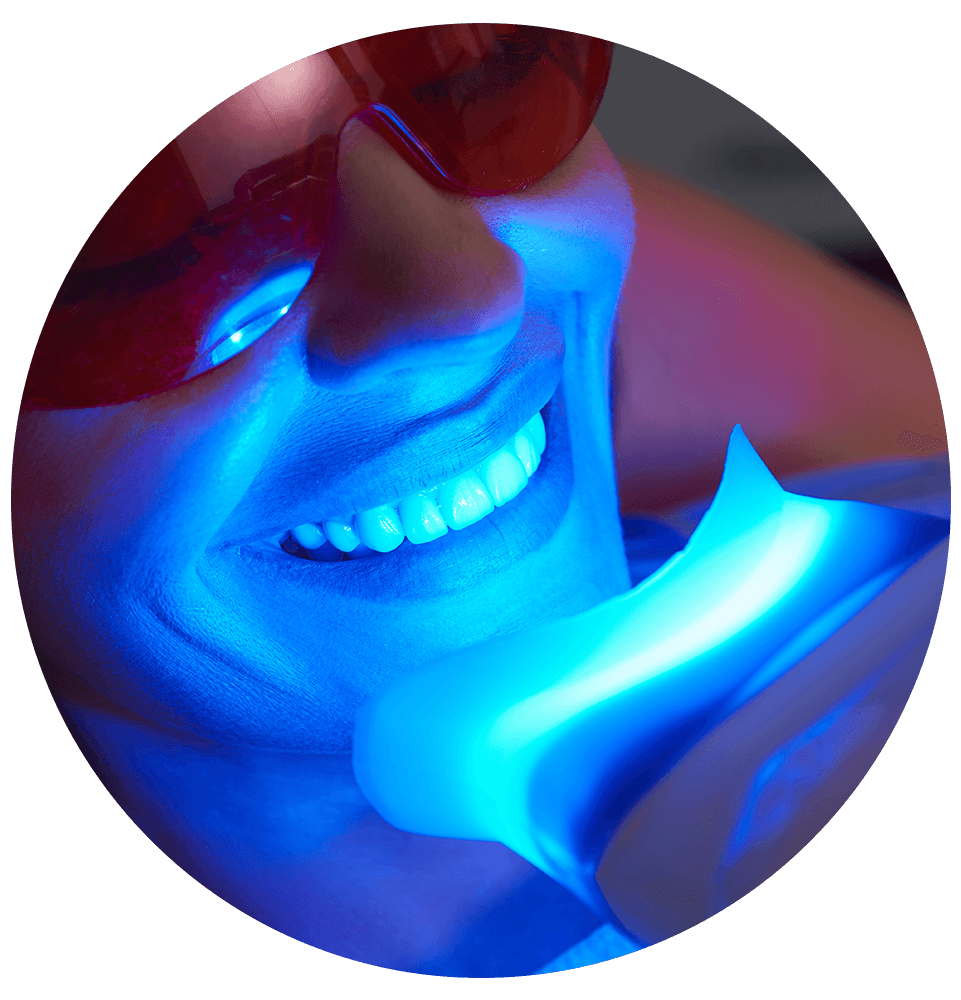 Adult woman is doing teeth whitening at home